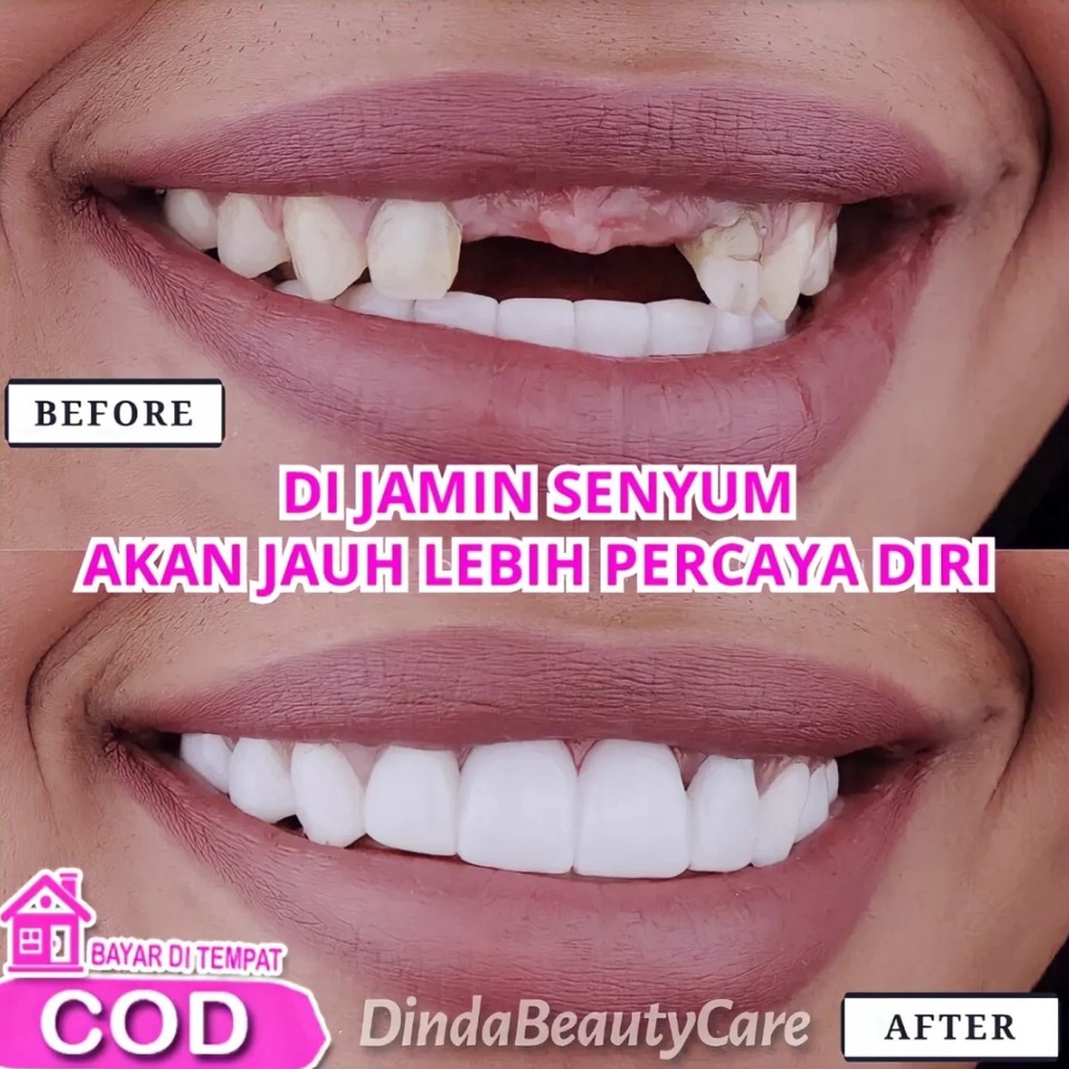 Ready Stok GIGI ATAS BAWAH GIGI LEPAS PASANG VENEER snap on smile