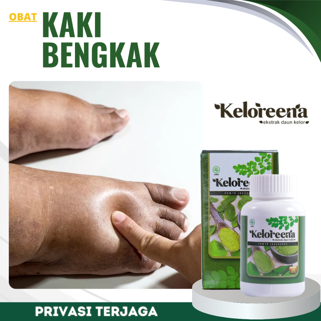 Obat Kaki Bengkak karena Gula / Diabetes, Obat Asam Urat, Obat Rematik, Obat Penumpukan Cairan Di Ka