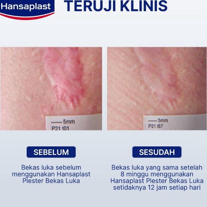 Terlaris Plester Keloid  Bekas luka Satuan Hansaplast