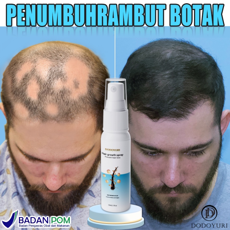 [BPOM] Penumbuh rambut cepat obat penumbuh rambut serum penumbuh rambut penumbuh rambut botak 30ml P