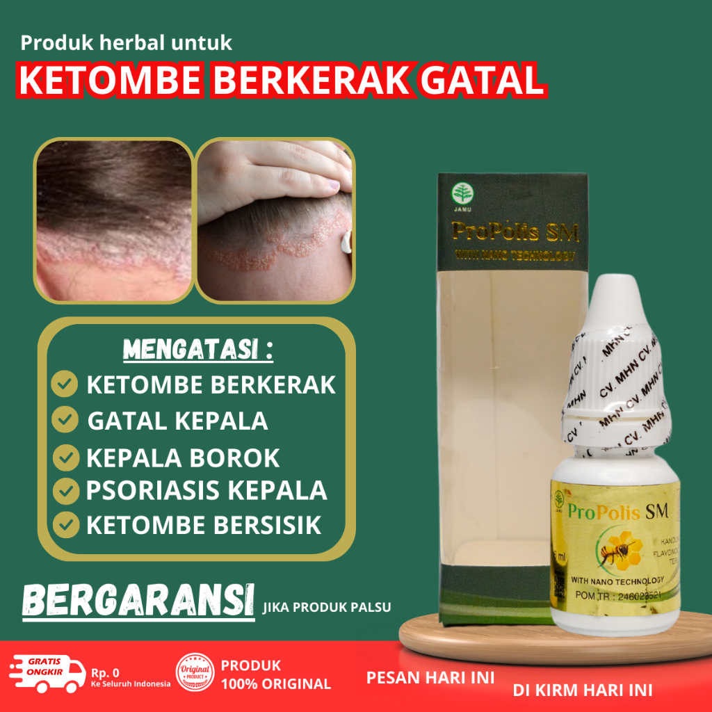 Obat Ketombe parah berkerak, Obat Ketombe dan gatal, Obat Psoriasis Kepala berkerak, Obat Kulit Kepa