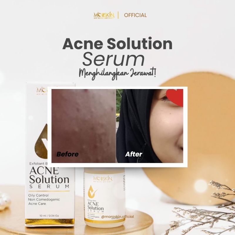 Moraskin Serum Acne || Serum Jerawat || Kulit Berminyak Komedo || Totol Jerawat