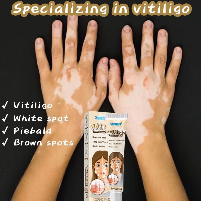 obat vitiligo salep vitiligo cream vitiligo penyakit kulit