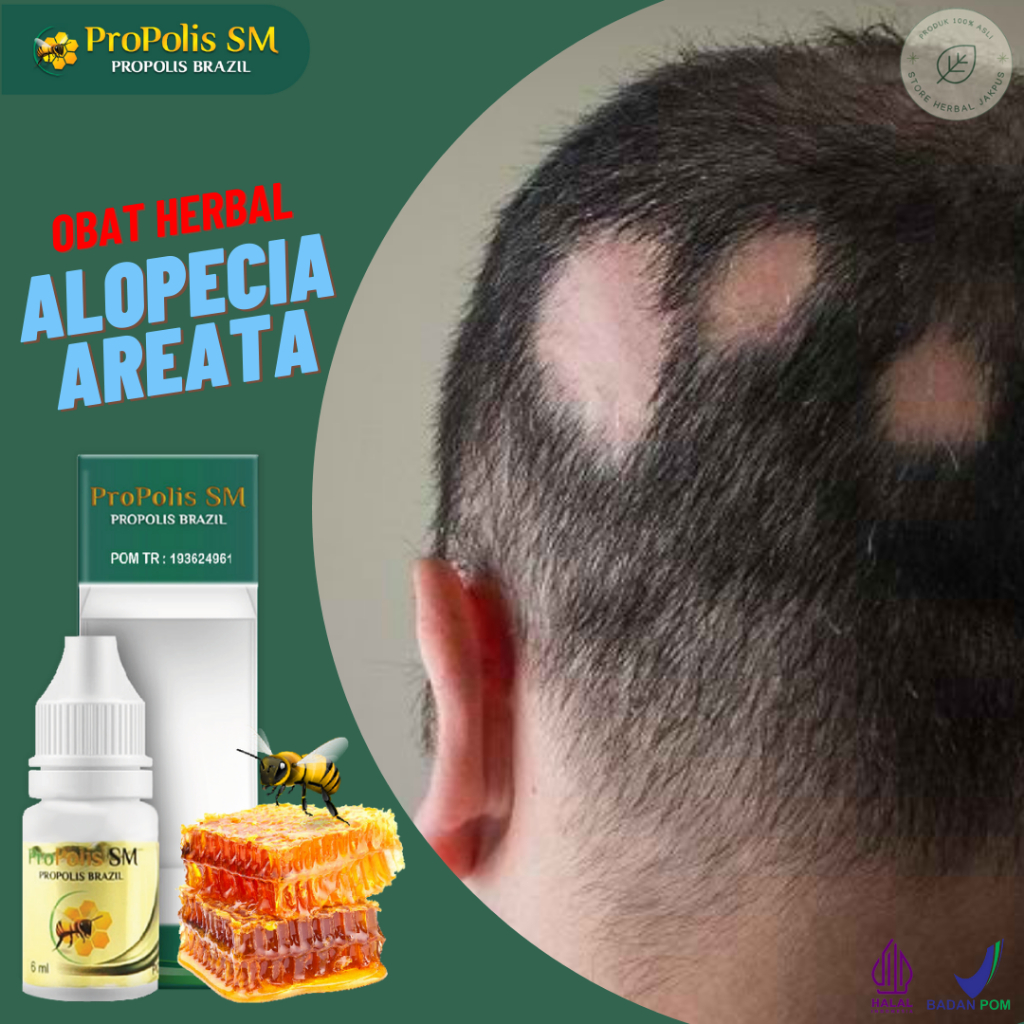 Obat Alopecia Areata Penumbuh Rambut Rontok Infeksi Jamur Kepala Kulit Kepala Gatal Borok