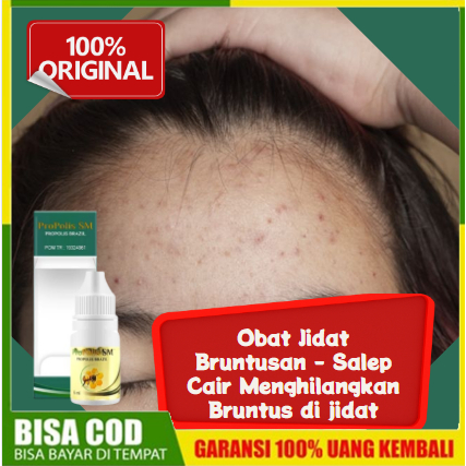 Obat Jidat Bruntusan - Salep Cair Menghilangkan Bruntus di jidat - Herbal Penghilang Papula, pustula