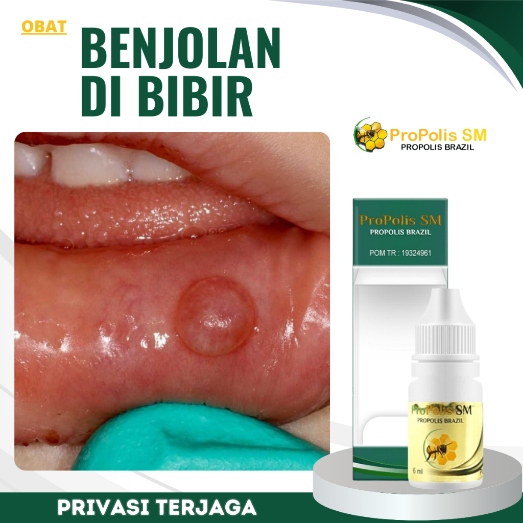 Obat Benjolan di Bibir Mulut Lidah, Obat Tumor Lidah, Kanker Lidah, Obat Pengempis Benjolan Berisi C