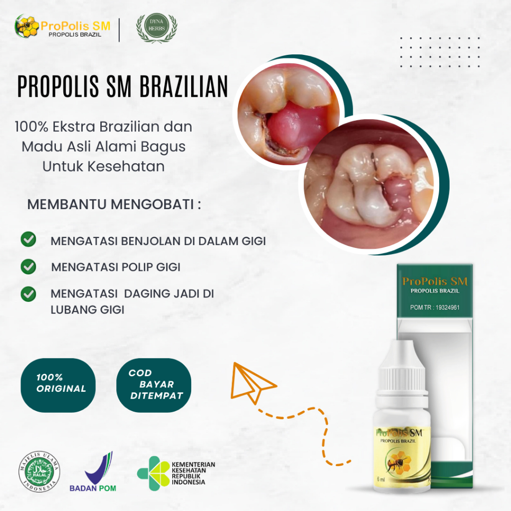 Obat Polip Gigi, Obat Penghilang Daging Di Lubang Gigi, Obat Polip Pulpa, Obat Daging Jadi, Obat Ben