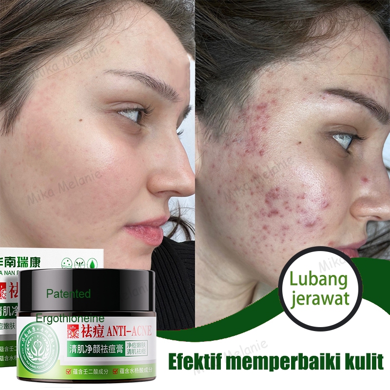 Bekas Jerawat Krim 30g PENGHILANG JERAWAT  Penghilang Bopeng Krim/Obat jerawat paling ampuh Penghila