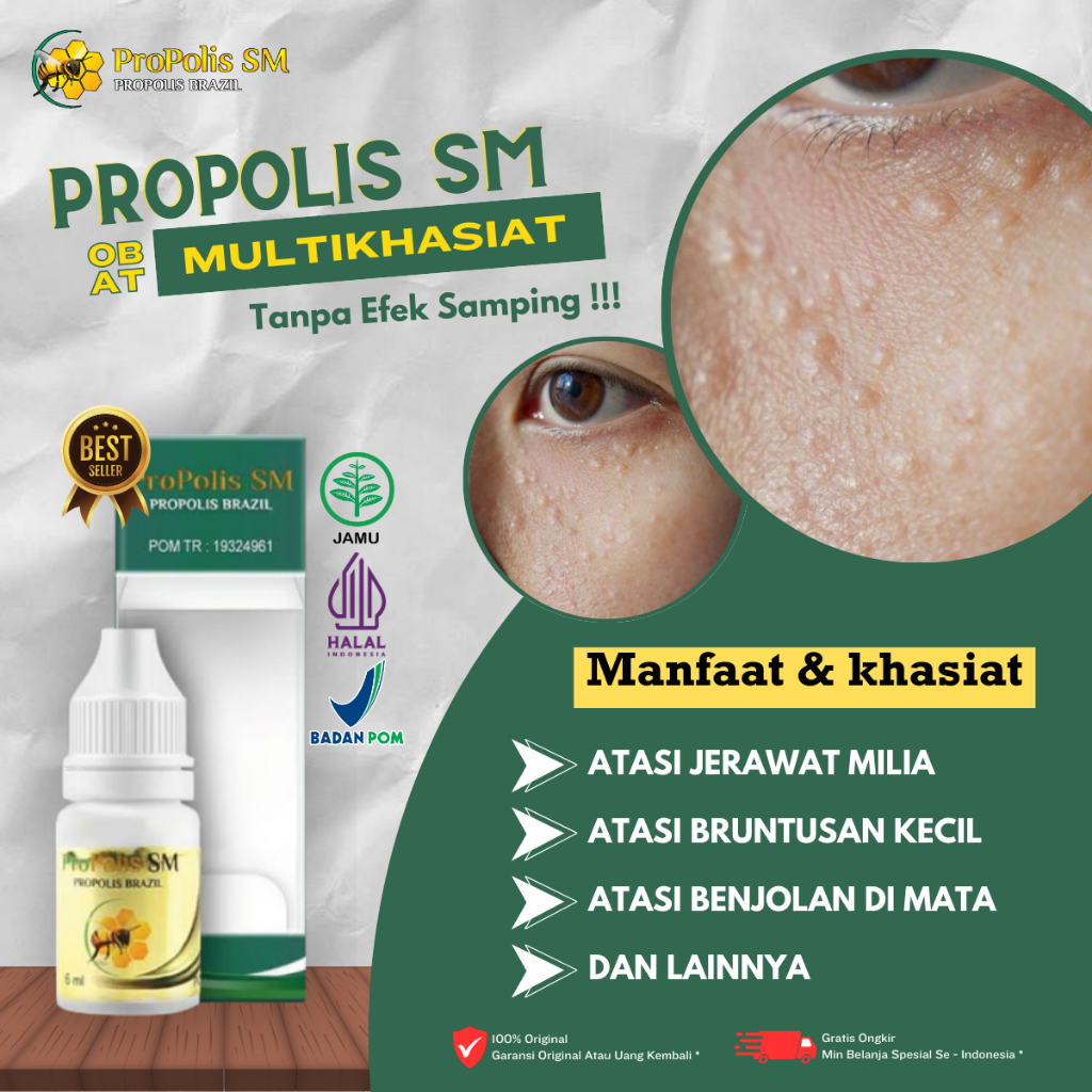 Obat Milia, Obat Milia Pada Wajah, Obat Penghilang Milia di Wajah, Obat Milia Di Kelopak Mata, Obat 