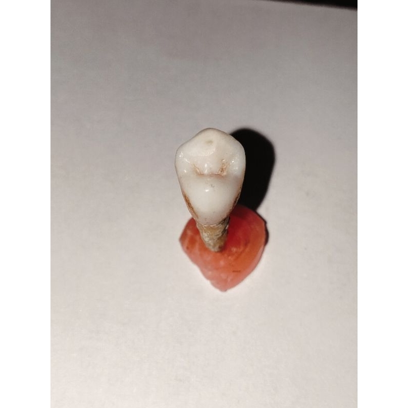 Gigi asli premolar 15