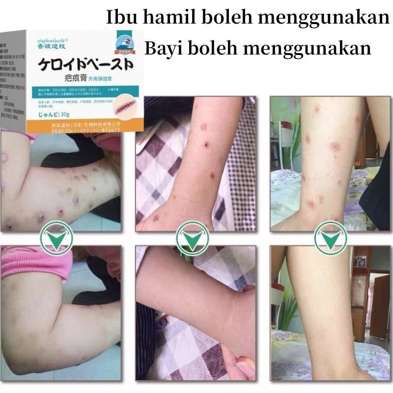 Obat Penghilang Bekas Luka menghilangkan bekas luka lama Menghilangkan bekas luka hitam Penghilang B