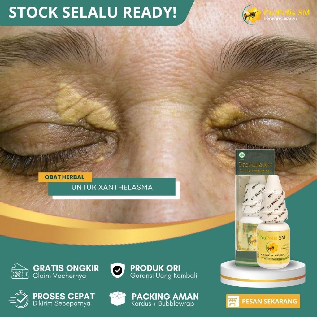 Obat Xanthelasma, Obat Herbal Mata Xanthelasma, Obat Penghilang Gumpalan lemak Di Kelopak Mata Xanth