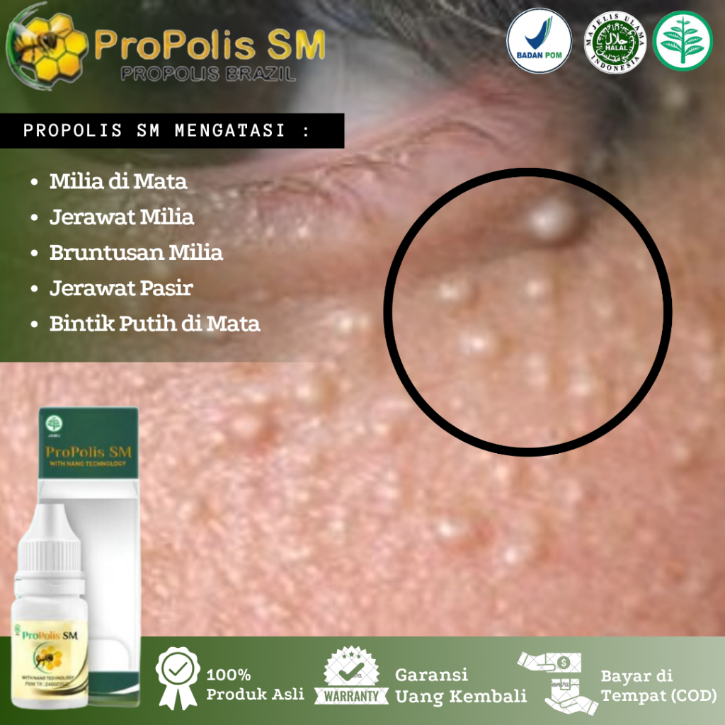 Propolis SM - Obat Oles Penghilang Milia, Milia Di Bawah Mata, Milia Di Kelopak Mata, Jerawat Milia,