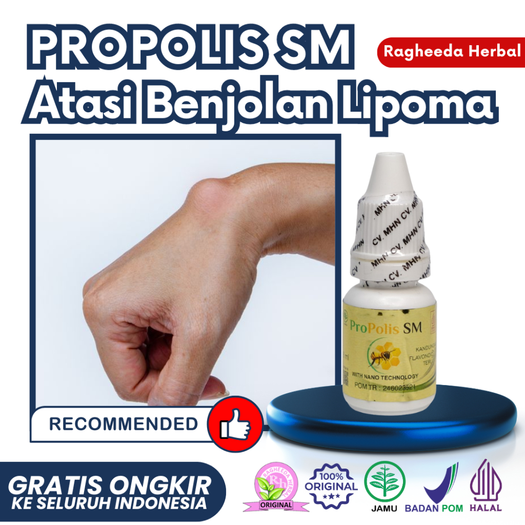 Obat Lipoma Benjolan Uci Uci Di Tangan - Leher - Ketiak - Payudara - Dahi - Punggung - Telinga - Dll