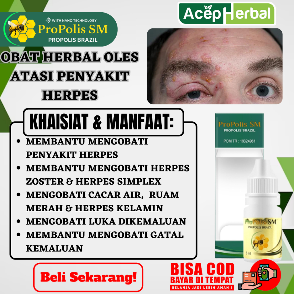 PROPOLIS SM Salep Oles Untuk Obat Herpes Atasi Obat herpes di bibir, herpes zoster, cacar air, cacar
