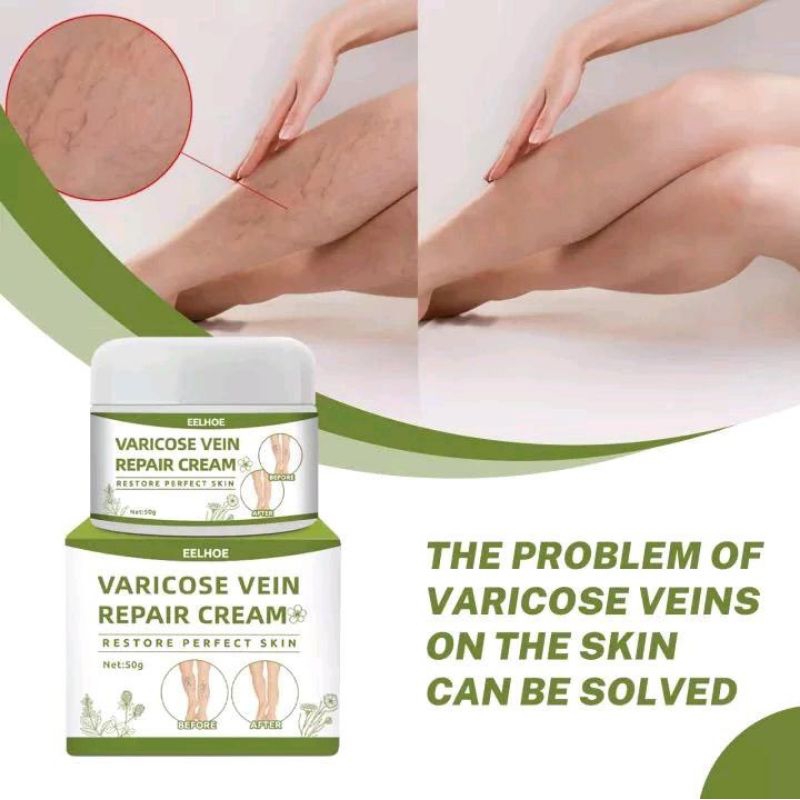 EELHOE VARICOSE VEINS REPAIR CREAM/ KRIM VARISES