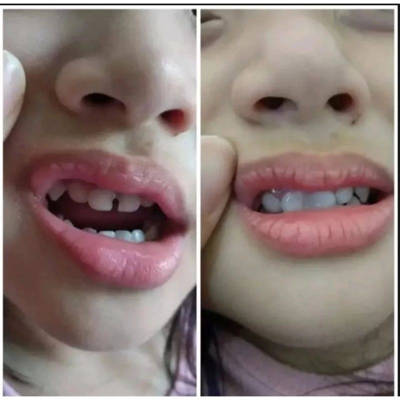 (special promo) Penambal gigi 100-250butir tambal gigi sendiri di rumah