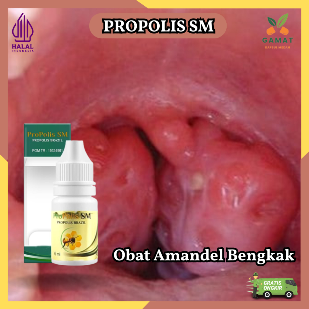 Propolis SM - Obat Amandel Bengkak, Amandel Anak Bengkak Sebelah, Bercak Putih di Amandel Cepat Kemp