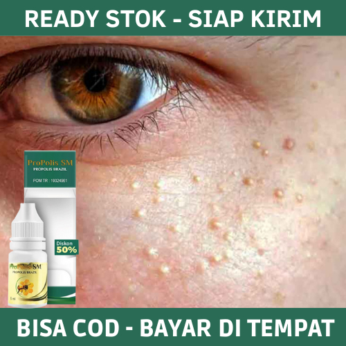 Obat Milia, Obat Milia Diarea Mata, Obat Bintik Putih di Wajah, Obat Milia di Wajah, Obat Milia Pada