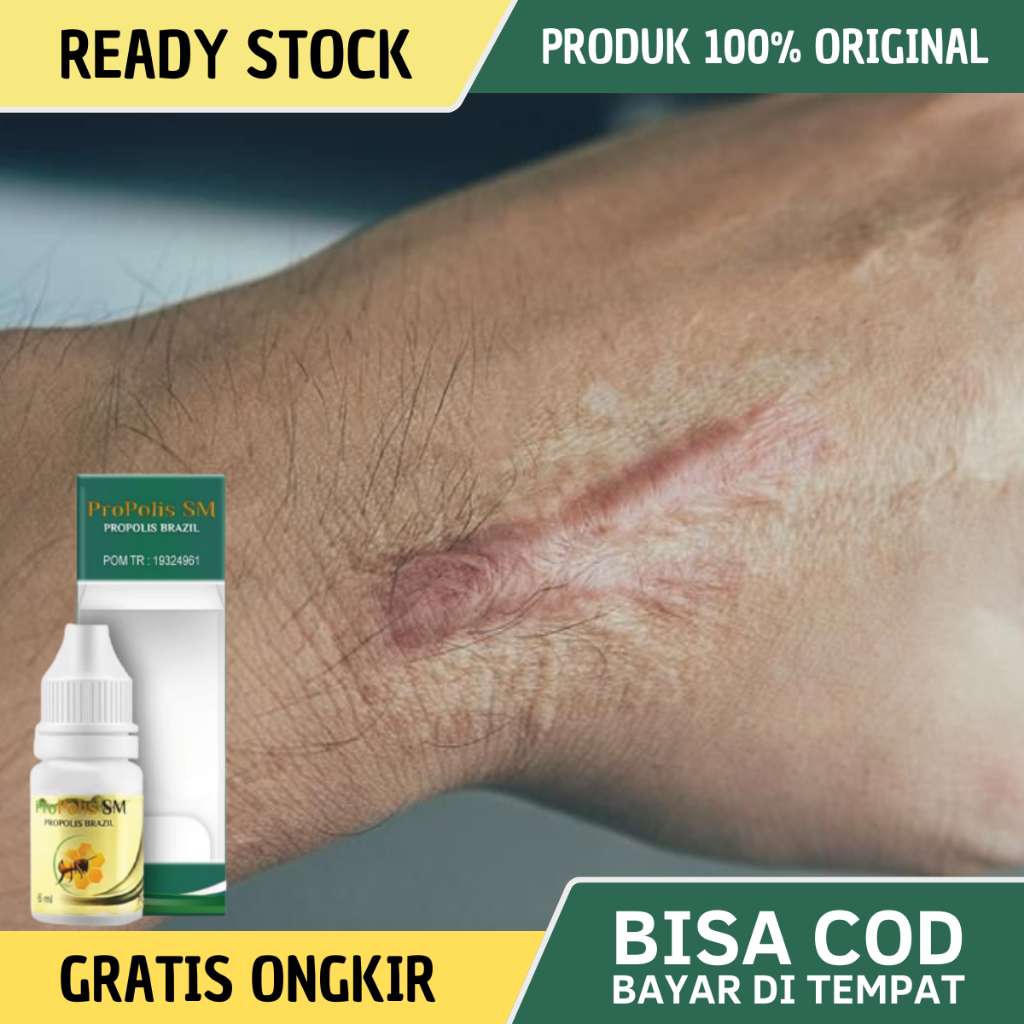 Obat Keloid, Obat Keloid Daging Tumbuh, Obat Daging Jadi, Obat Keloid Menahun, Obat Keloid Tahunan, 