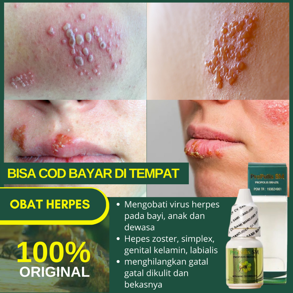 Obat Oles Herpes Kelamin, Herpes Genital, Herpes Zoster, Herpes Simplex, Cacar Ular, Cacar Monyet, C