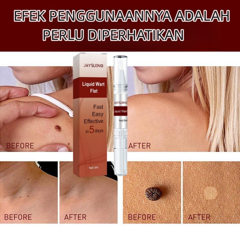 Penghilang kutil wart remover pen Penghilang Tahi Lalat Penghilang Kutil Skin Tag Remover Menghilangkan Tahi Lalat