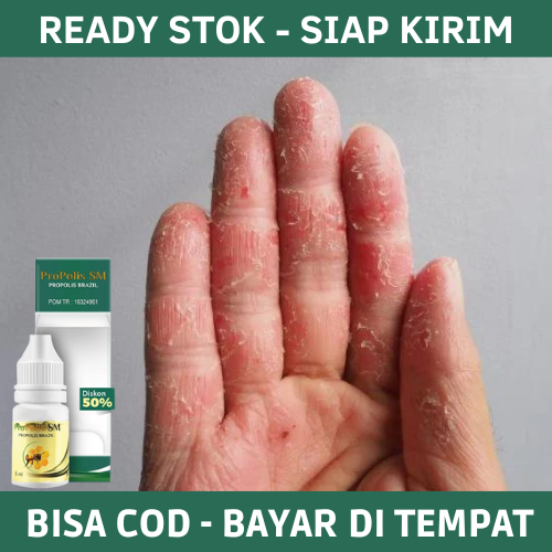 Obat Oles Kulit Jari Tangan Kering, Obat Kulit Jari Tangan Pecah Pecah, Obat Kulit Jari Tangan Menge