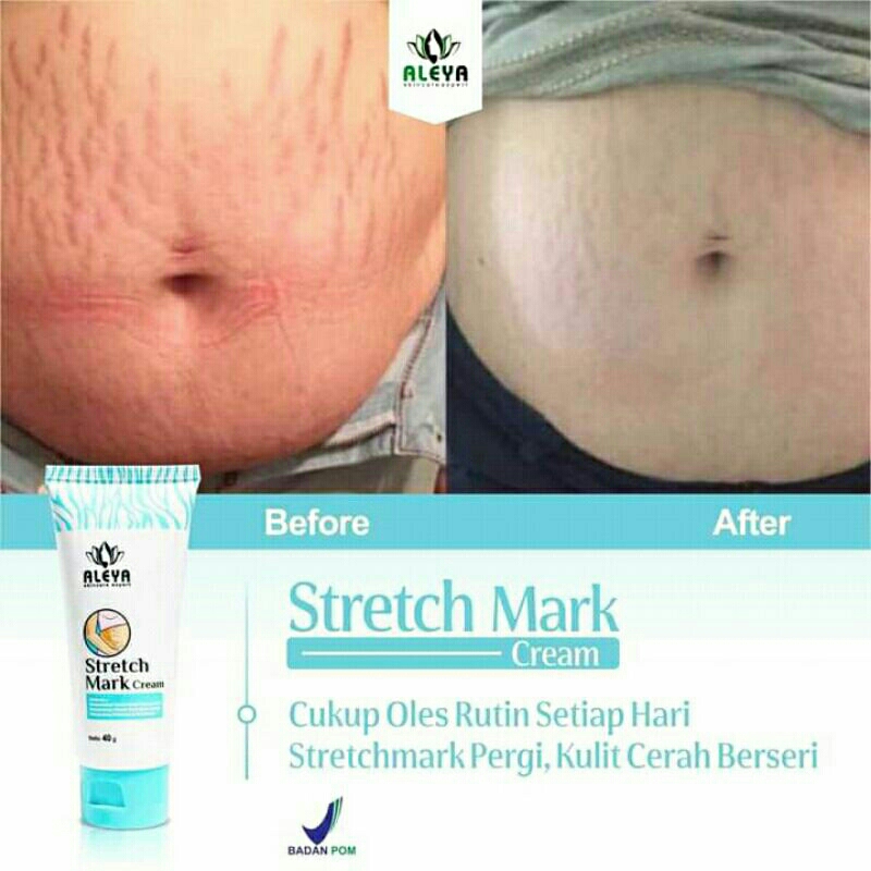 Cream stretch mark Aleya penghilang stretch mark BPOM Original