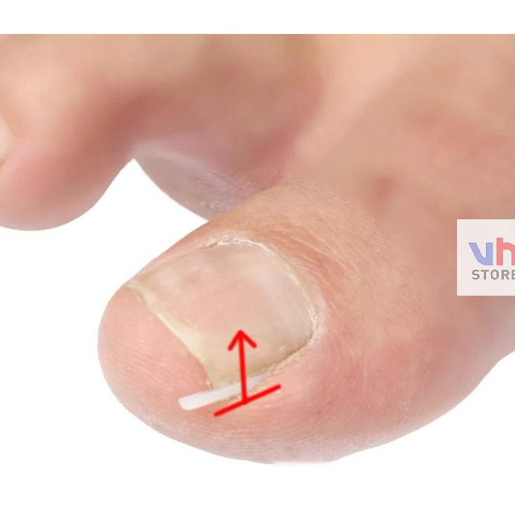 Buruan Beli Bantalan Silikon Kuku Ingrown Nail Isolation Pad Mencegah Cantengan