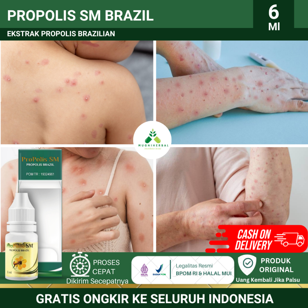 Proplis SM - Obat Cacar Air, Cacar Api, Cacar Monyet, Herpes Kulit, Cacar Bernanah, Obat Penghilang 