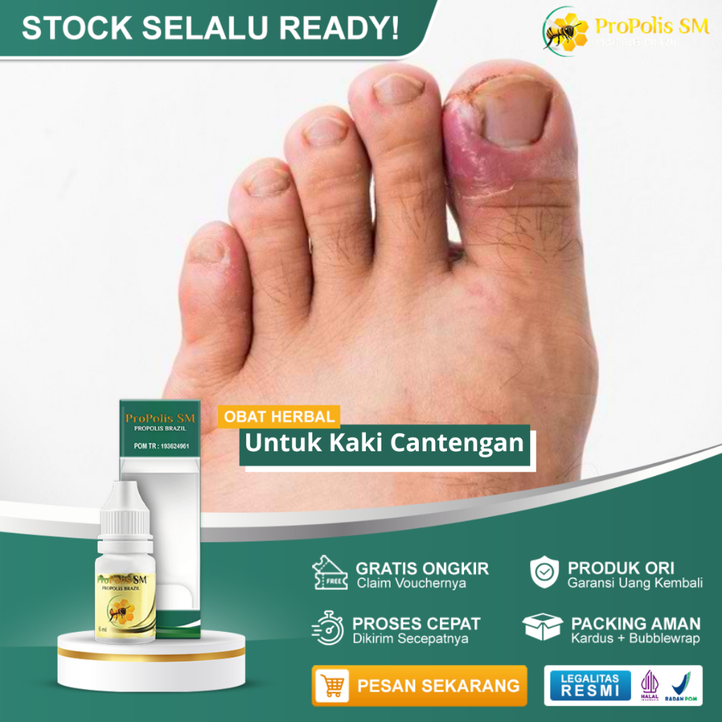 Obat Cantengan Jempol Kaki Tangan, Obat Cantengan Kuku, Obat Cantengan Bengkak Dan Bernanah, Obat Ca