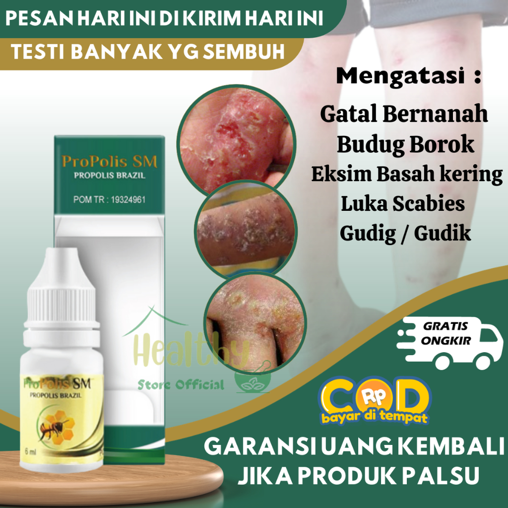 Obat Scabies Manusia, Obat Gatal Kulit Seluruh Badan, Obat Budug Kulit Gatal, Obat Scabies Kulit Bor