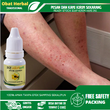 Obat Alergi Semen, Obat Kulit Ruam Kemerahan Karena Alergi Semen, Dermatitis Kontak, Atopik, Seboroi
