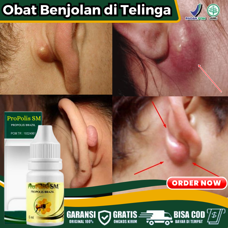 Obat Benjolan di Daun Telinga, Benjolan di Samping Telinga, Benjolan di Dekat Telinga, Bisul di Teli