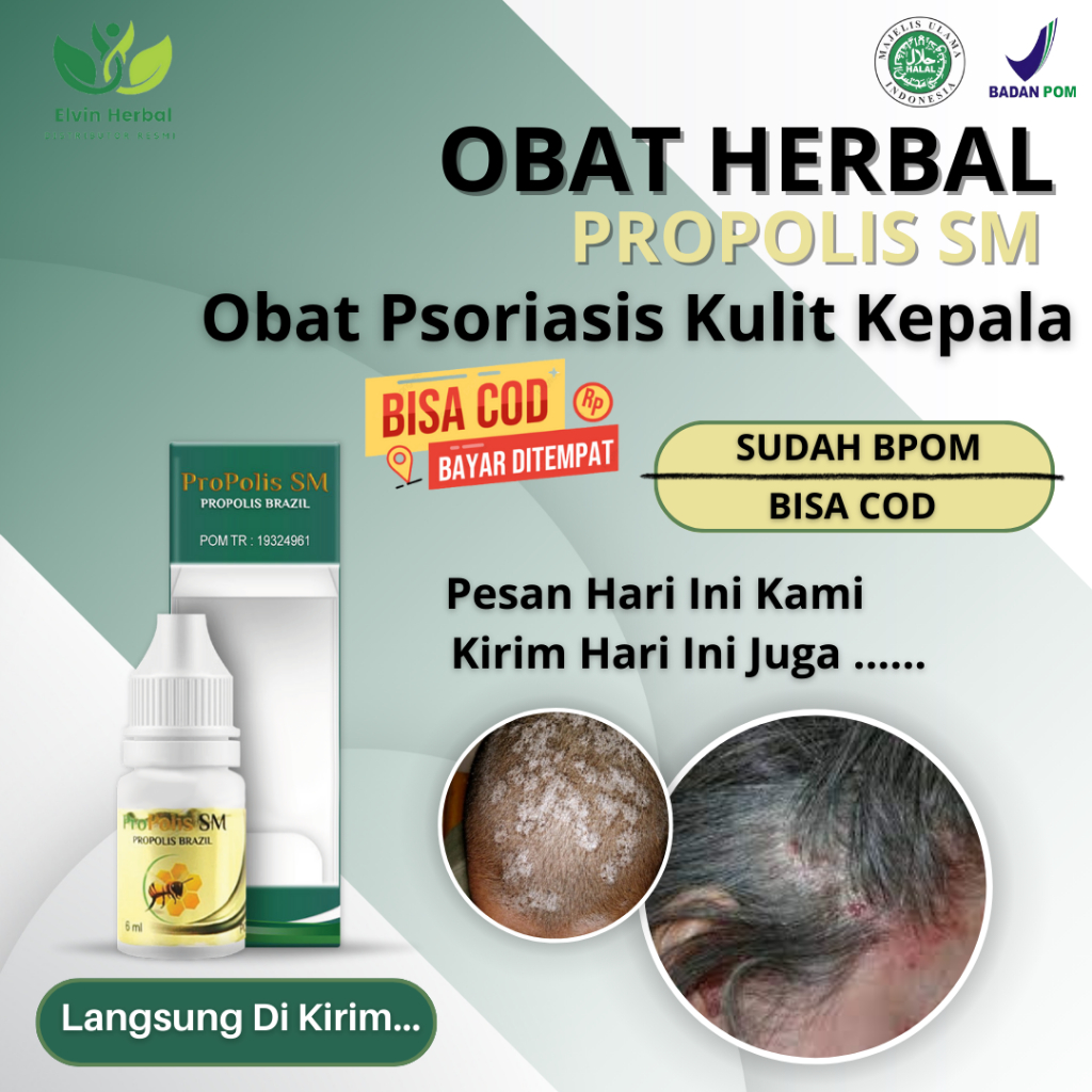Obat Borok di Kepala, Obat Psoriasis Kulit Kepala, Obat Koreng Kepala, Obat Ketombe dan Rambut Ronto