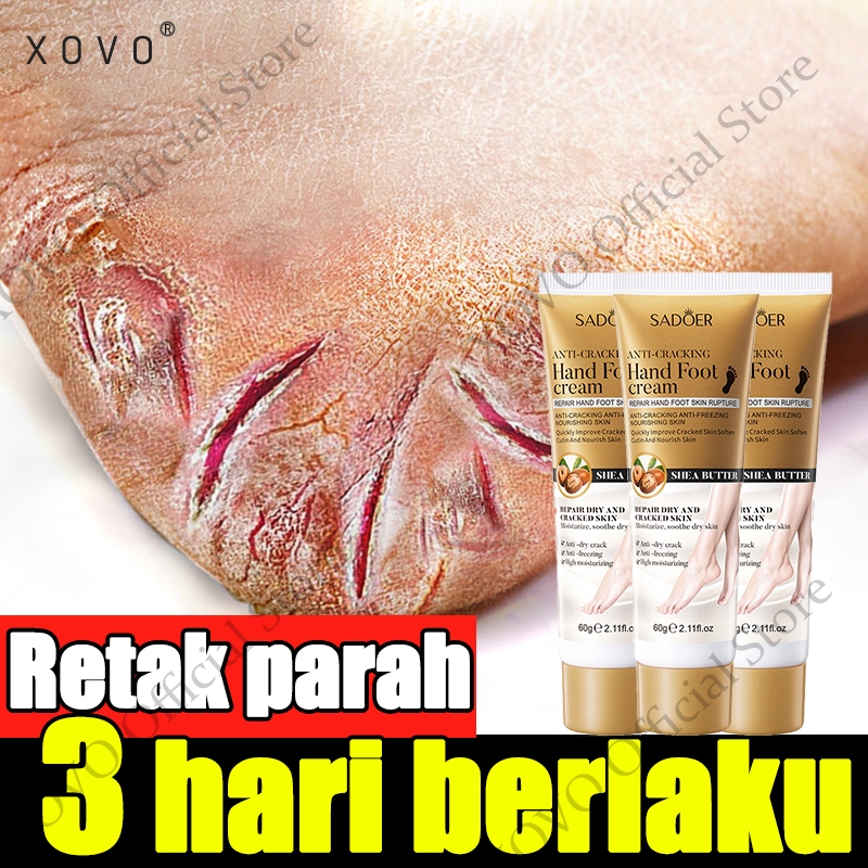 kaki obat kaki pecah dan kering krim  ​obat kaki pecah pecah 60g  alat kaki pecah pecah cream kaki p