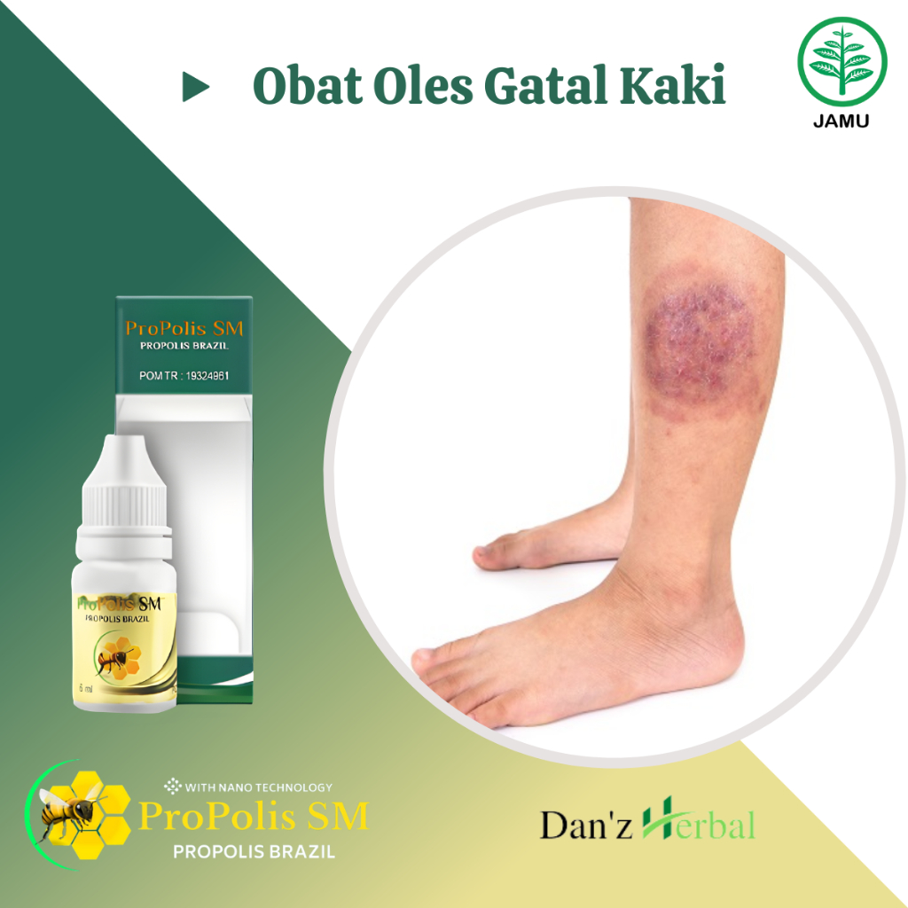 Obat Gatal Kaki, Gatal Budug di Kaki, Obat Gatal Kaki Berair, Obat Gatal Kaki Pecah Pecah, Obat Gata