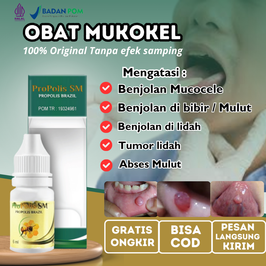 Obat Mukokel, Penghilang benjolan di bawah lidah, Obat benjolan mulut, Obat Benjolan Di Bibir Mulut