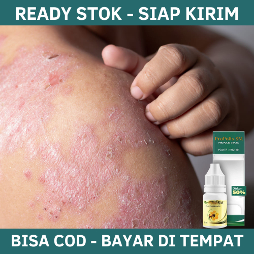 Obat Eksim, Obat Gatal Eksim, Obat Gatal Exim Kering Menahun, Obat Untuk Gatal2 Kering, Obat Gatal M