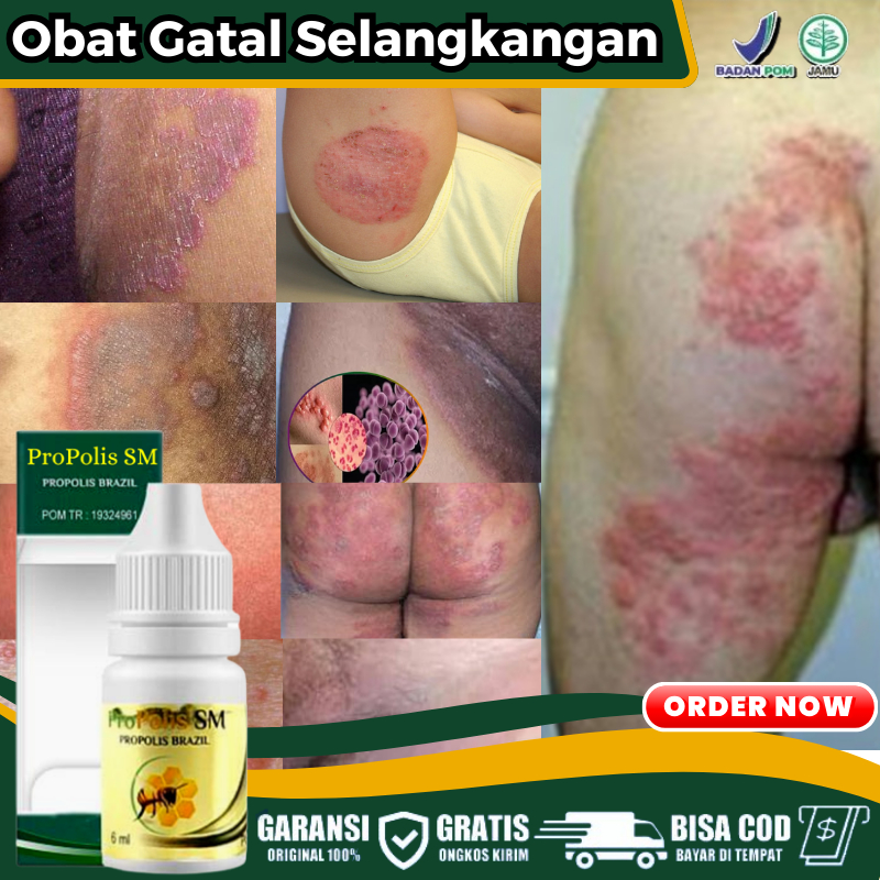 Obat Oles Penghilang Gatal di Bokong, Obat Pantat Gatal Ruam Merah Melingkar & Lecet Parah Pantat Ga