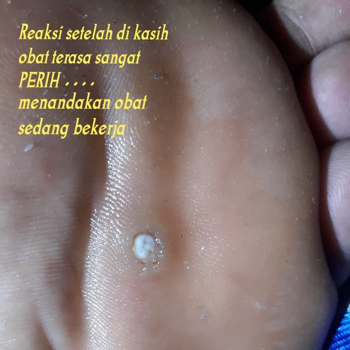 Paling ampuh Obat mata ikan |  【100% Original】 Obat Mata Ikan Telapak Kaki dan Tanagan Callusol - Ob