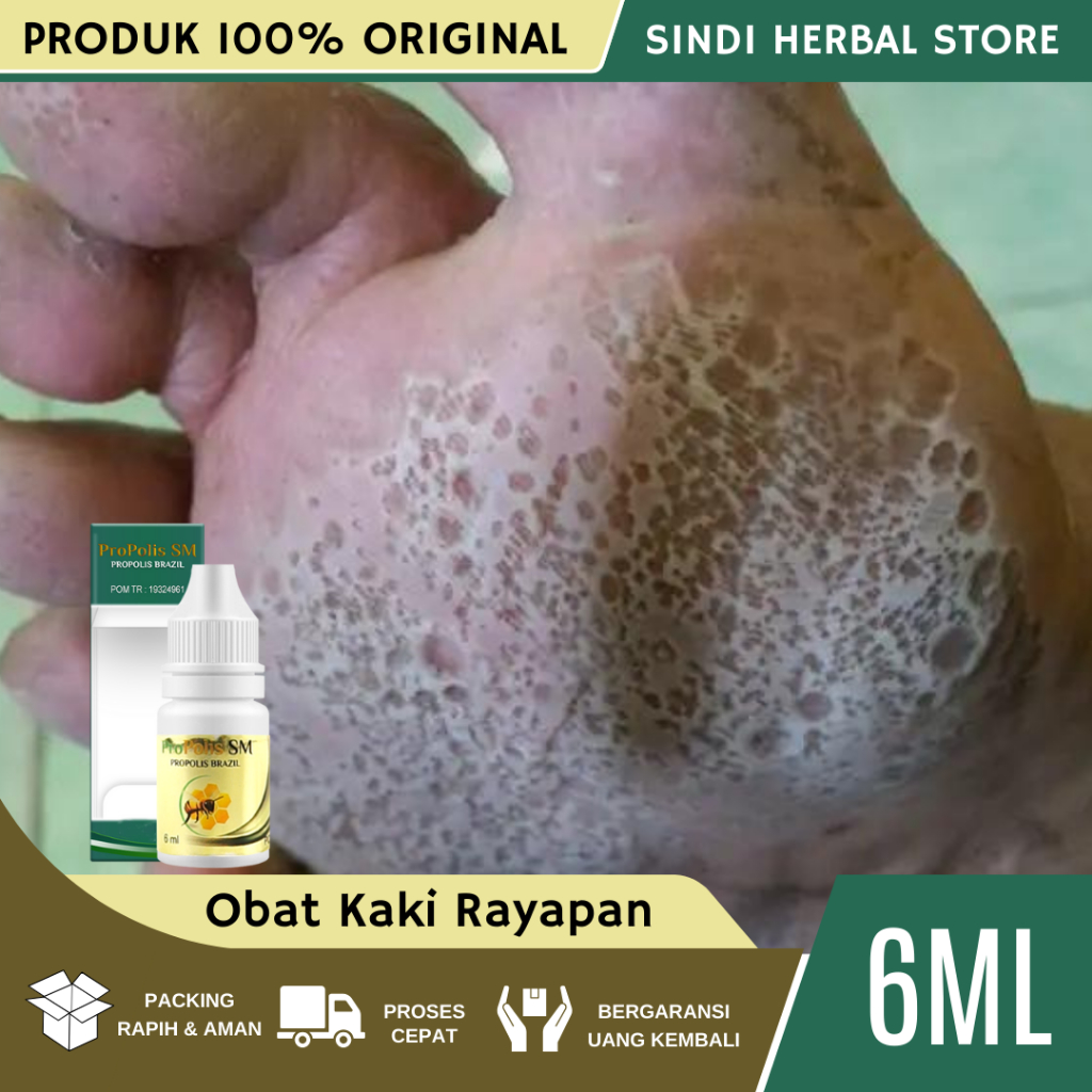 Obat Kaki Rayapan dan Bau, Obat Telapak Kaki Bolong Bau, Obat Oles Kaki Rayapan, Obat Tetes Kaki Bol