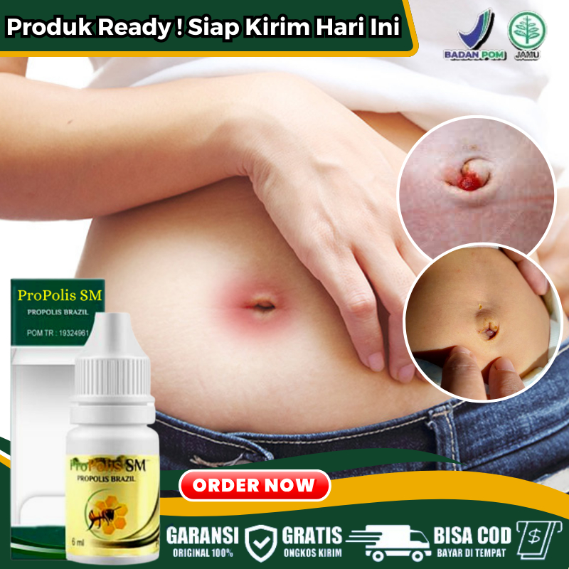 Obat Oles Pusar Keluar Nanah & Berdarah Obat Alami Pengering Luka Pusar Bayi Obat Borok di Pusar Oba