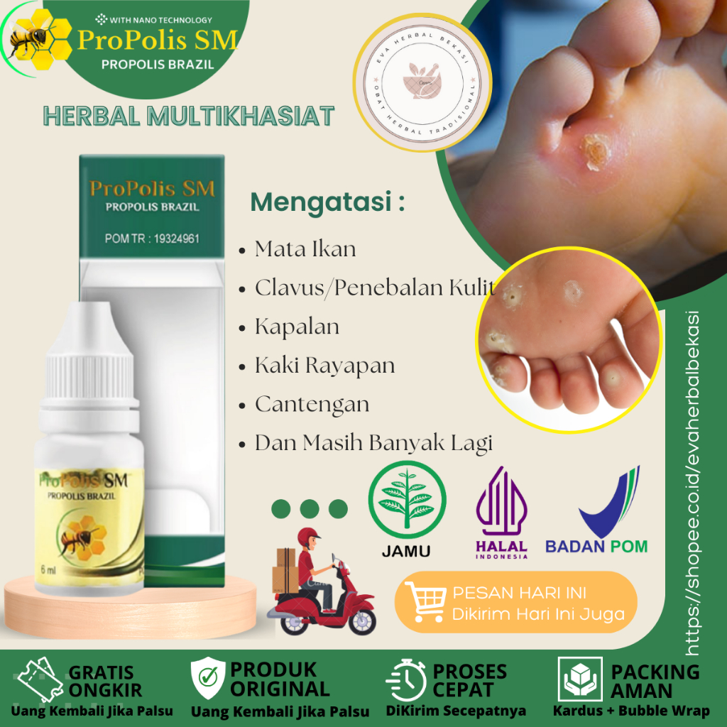 Obat Mata Ikan Di Telapak Kaki Dan Tangan, Obat Clavus/ Penebalan Kulit, Obat Kapalan, Obat Penghila