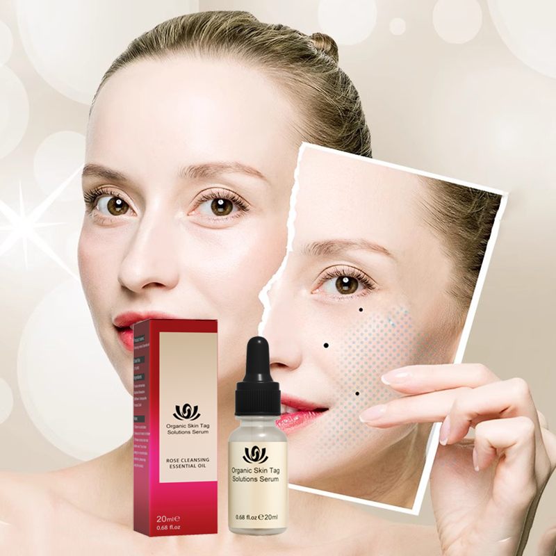 Minyak Esensial Penghilang Lalat Penghilang Tahi Lalat Penghilang Kutil Skin Tag Remover Tahi Lalat 