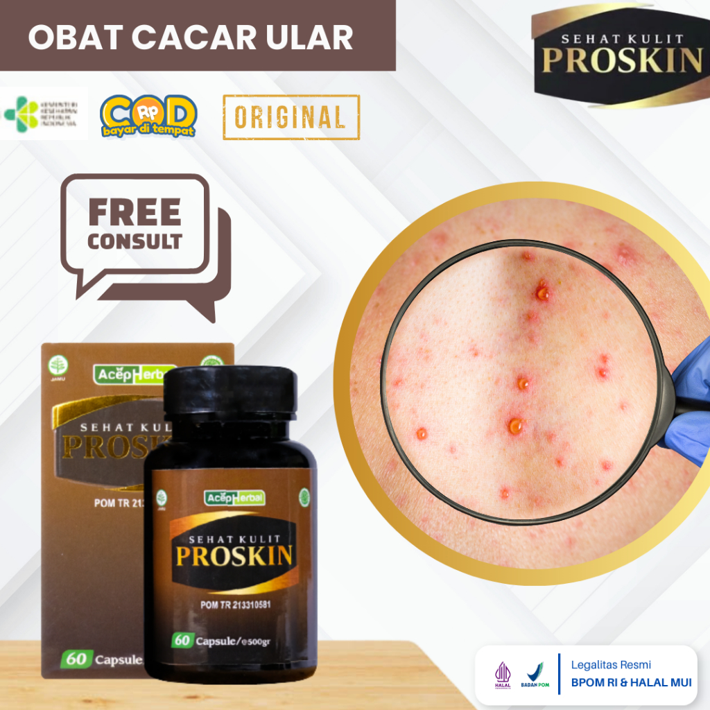 Obat Cacar Ular, Obat Herpes Zoster, Obat Penghilang Bekas Cacar Ular, Obat Cacar Air, Obat Cacar ap