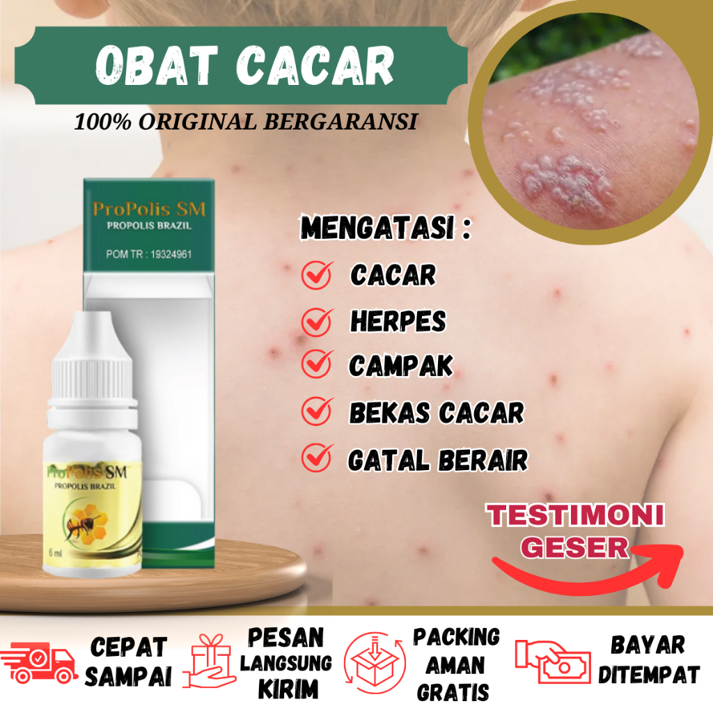 Penghilang Bekas Cacar Tampek Cacar Api Kulit Bintik Berair Herpes, Obat Penghilang Cacar, Obat Gata