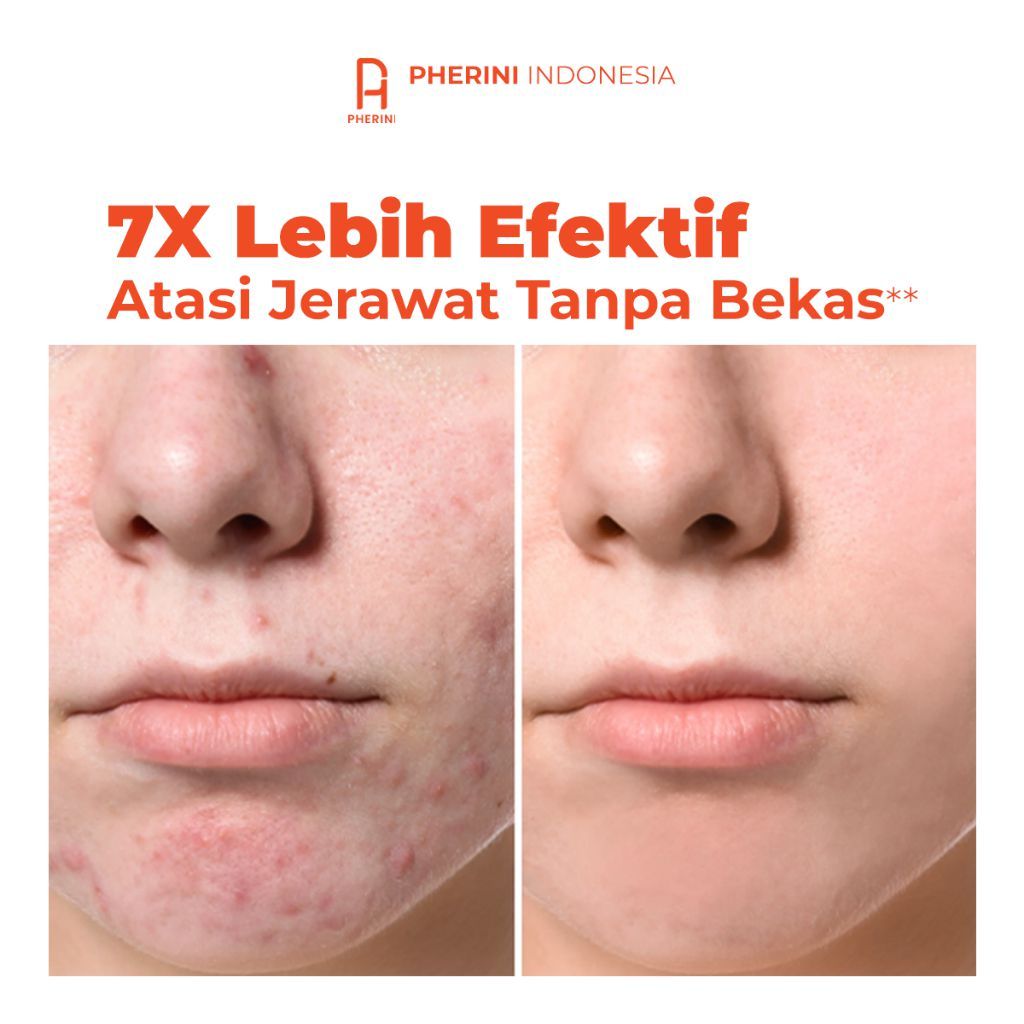 PHERINI Dell Acne Gel - Acne Spot Treatment - Obat Totol Jerawat dan Bekas Jerawat BPOM