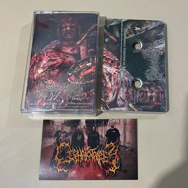 CS CEPHALOTRIPSY - Uterovaginal