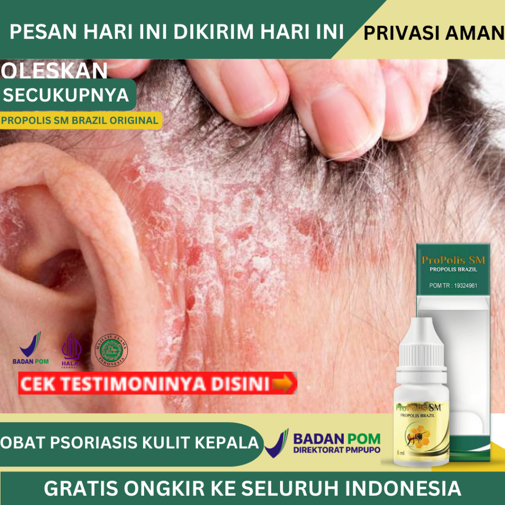 Obat Kulit Kepala Bersisik, Obat Kulit Kepala Berkerak, Psoriasis Kulit Kepala, Obat Ketombe Gatal B
